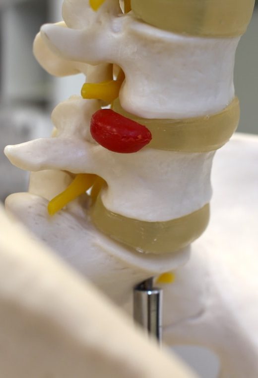 herniated disc treatment in Enfield