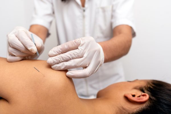 Acupuncture and Dry Needling in Enfield