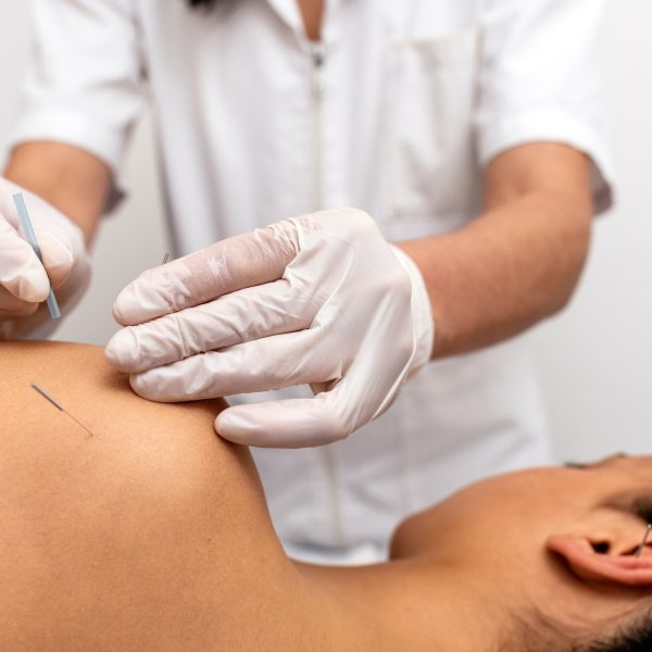 Acupuncture and Dry Needling in Enfield